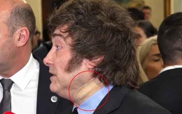 Milei en Madrid: la venda en el cuello que disparó preguntas y la versión oficial del «corte al afeitarse»
