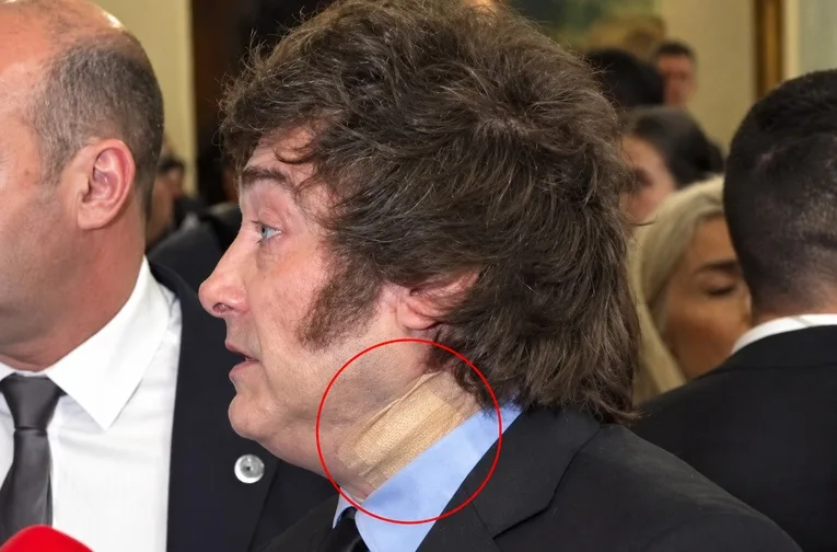 Milei en Madrid: la venda en el cuello que disparó preguntas y la versión oficial del "corte al afeitarse"